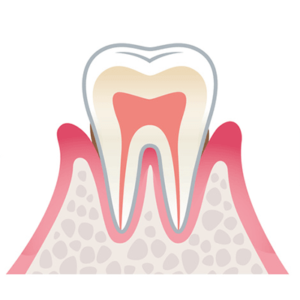 軽度の歯周病