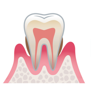 中等度の歯周病