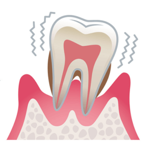 重度の歯周病